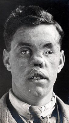 ww1_plastic_surgery_015.jpg
