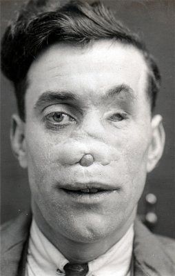 ww1_plastic_surgery_016.jpg