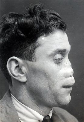 ww1_plastic_surgery_017.jpg