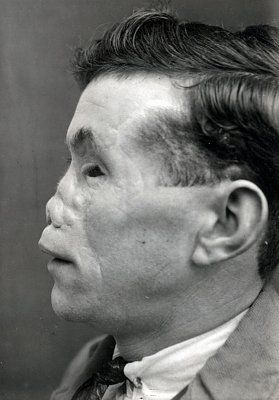 ww1_plastic_surgery_018.jpg