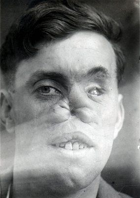 ww1_plastic_surgery_019.jpg