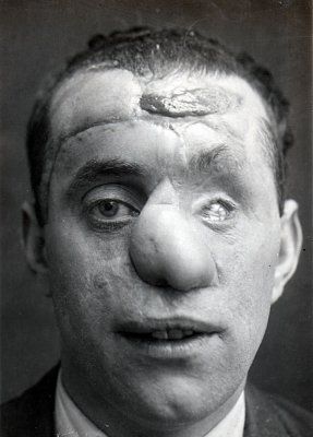 ww1_plastic_surgery_022.jpg