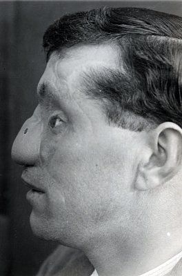 ww1_plastic_surgery_023.jpg