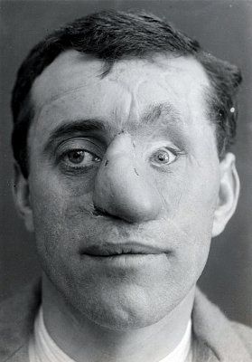 ww1_plastic_surgery_024.jpg