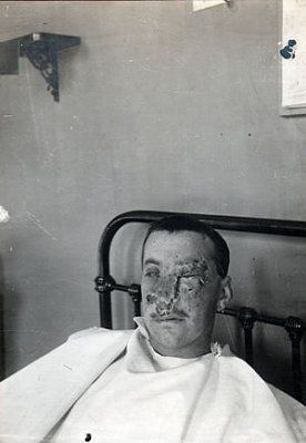 ww1_plastic_surgery_035.jpg