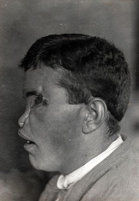 ww1_plastic_surgery_036.jpg