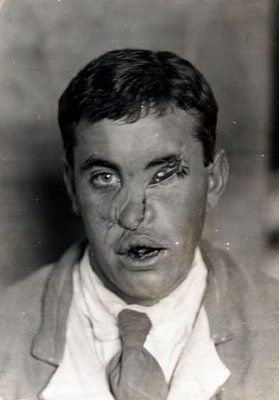 ww1_plastic_surgery_037.jpg