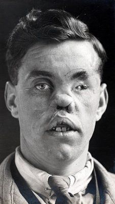 ww1_plastic_surgery_040.jpg