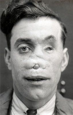 ww1_plastic_surgery_041.jpg