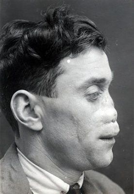 ww1_plastic_surgery_042.jpg