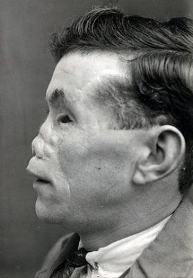 ww1_plastic_surgery_043.jpg