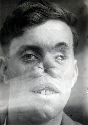 ww1_plastic_surgery_044.jpg
