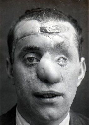 ww1_plastic_surgery_047.jpg