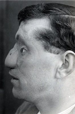 ww1_plastic_surgery_048.jpg