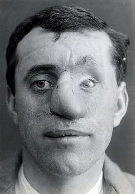 ww1_plastic_surgery_049.jpg