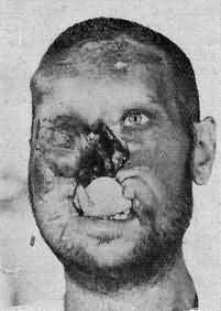 Name:  dentmutilmaxfac-p53b.jpg
Views: 248
Size:  7.4 KB
