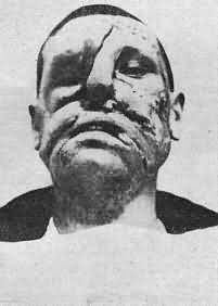 Name:  dentmutilmaxfac-p53c.jpg
Views: 250
Size:  6.7 KB