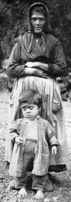 figure-1-hydrocephalic-dwarf-cretin-ribota-asturia-goitrous-mother-prematurely.jpg