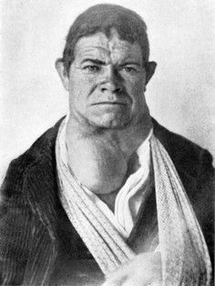 Figure-2-Goitrous-cretin-from-the-Pyrenees-after-Marimon.jpg