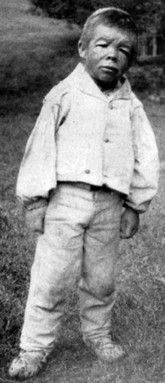 Figure-5-Cretin-without-goitre-aged-32-from-the-Carpathians-after-D-Adaroenko.jpg