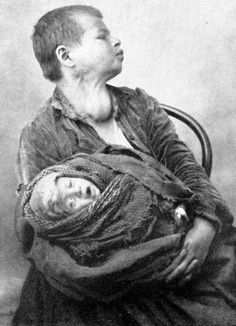 Figure-8-A-28-year-old-Jewish-cretin-and-child-from-the-Bukovina-from-A-Flinker.jpg
