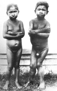 Figure-9-Fully-grown-siblings-without-goitre-from-Java-after-Eerland.jpg