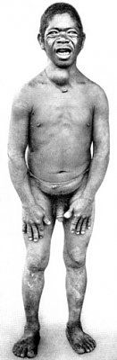 figure-10-0-goitrous-cretin-sumatra-after-von-bommel.jpg