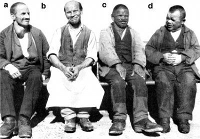 figure-11-9-group-cretins-c-goitrous-d-without-goitre-riggisberg-institution.jpg