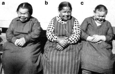 Figure-12-0-Group-of-cretins-without-goitre-Riggisberg-Institution.jpg