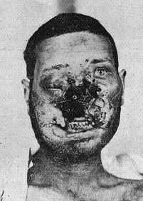 ww1%20injury%201.jpg