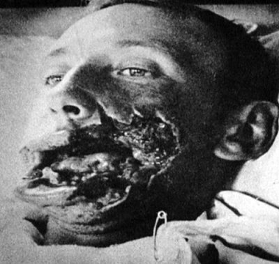 ww1-20injury-203.jpg