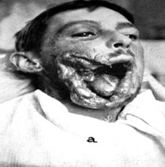 ww1%20injury%205.jpg