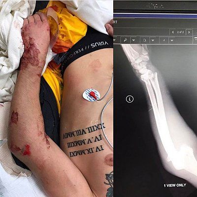 ken-roczen-crash-injury-x-ray-20-20copy.jpg