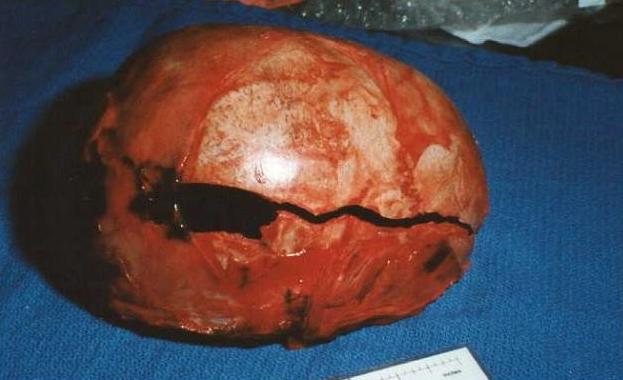 Crackedskull.jpg