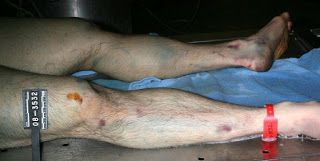 travis%20alexander%20autopsy%20photo%20legs.jpg
