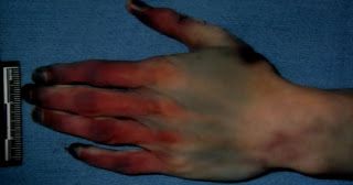 travis%20alexander%20autopsy%20photo%20wounds%20on%20hands.jpg