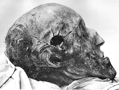 charlesxiiautopsy19161.jpg