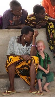 The Perils of Pale Skin_Albino Killings in Tanzania(1).jpg