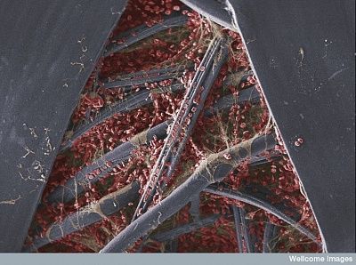 blood_clot_on_gauze.jpg