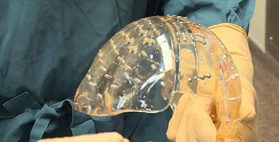 surgeons-replace-skull-3d-printed-plastic-cap.jpg