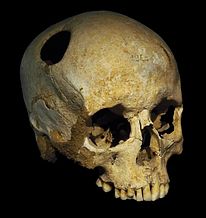 trepanning.jpg