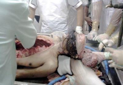michael_jackson_autopsy_photo.jpg