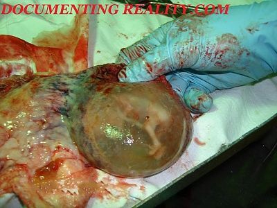 autopsy-woman-22-week-fetus.jpg