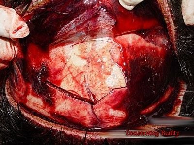 gunshot-head-breaks-skull-glass-01.jpg