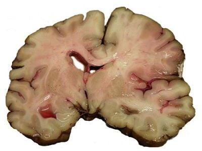 slice-brain-autopsy-person-who-suffered-acute-middle-cerebral-artery-mca-.jpg
