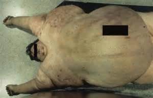 obese5.jpg