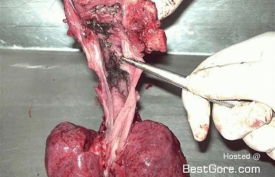 autopsy-burnt-child-04.jpg