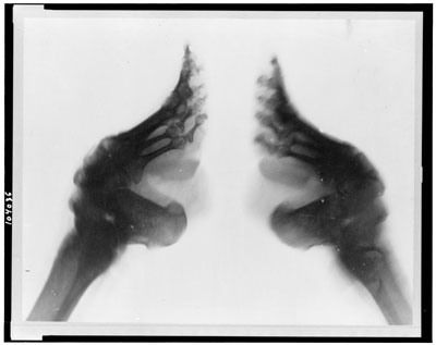 foot-xray.jpg