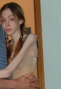 anorexia1.jpg