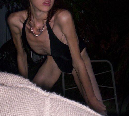 Anorexia2.jpg